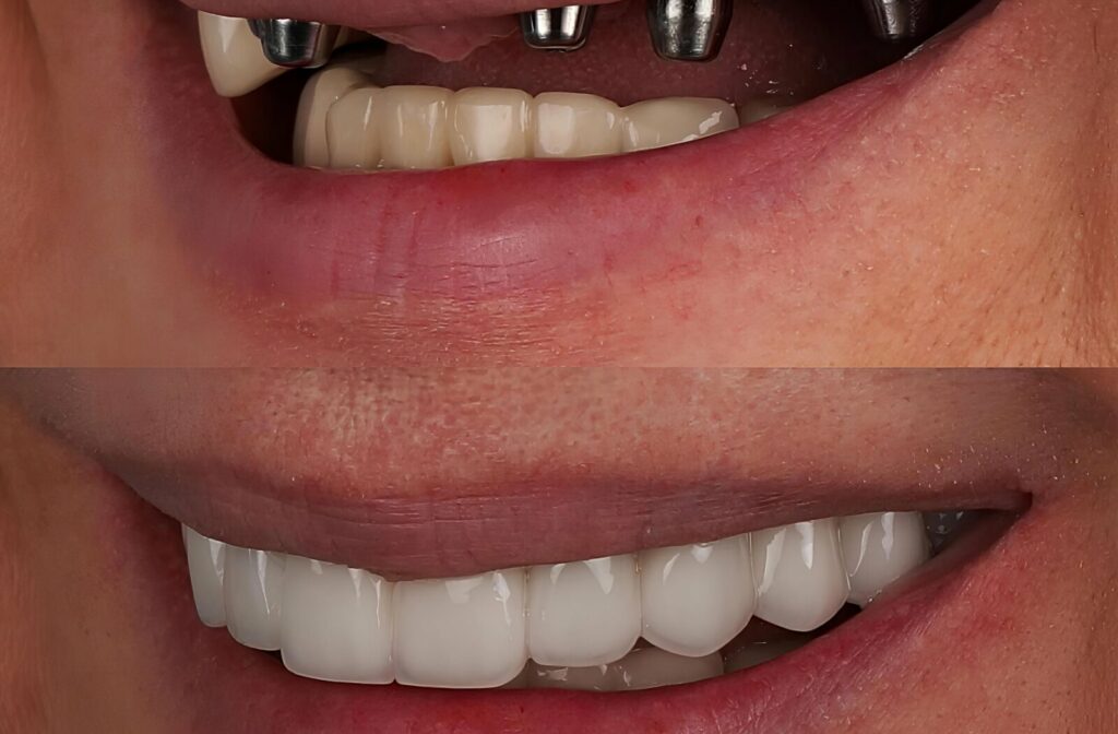 A before and after picture of a person whose smile has been restored by dental implants.