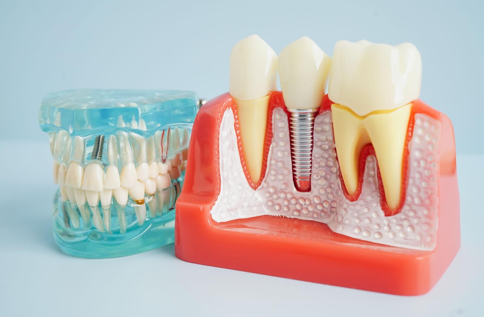 A model of a dental implant, showing the titanium root surgically placed in the jawbone.