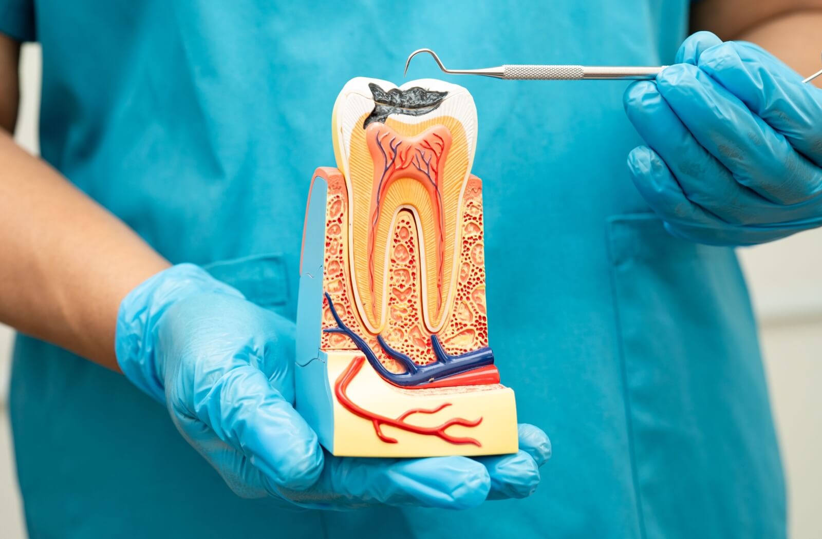 A dental professional holding a cross-section model of a tooth showing a deep cavity and nerve structure.